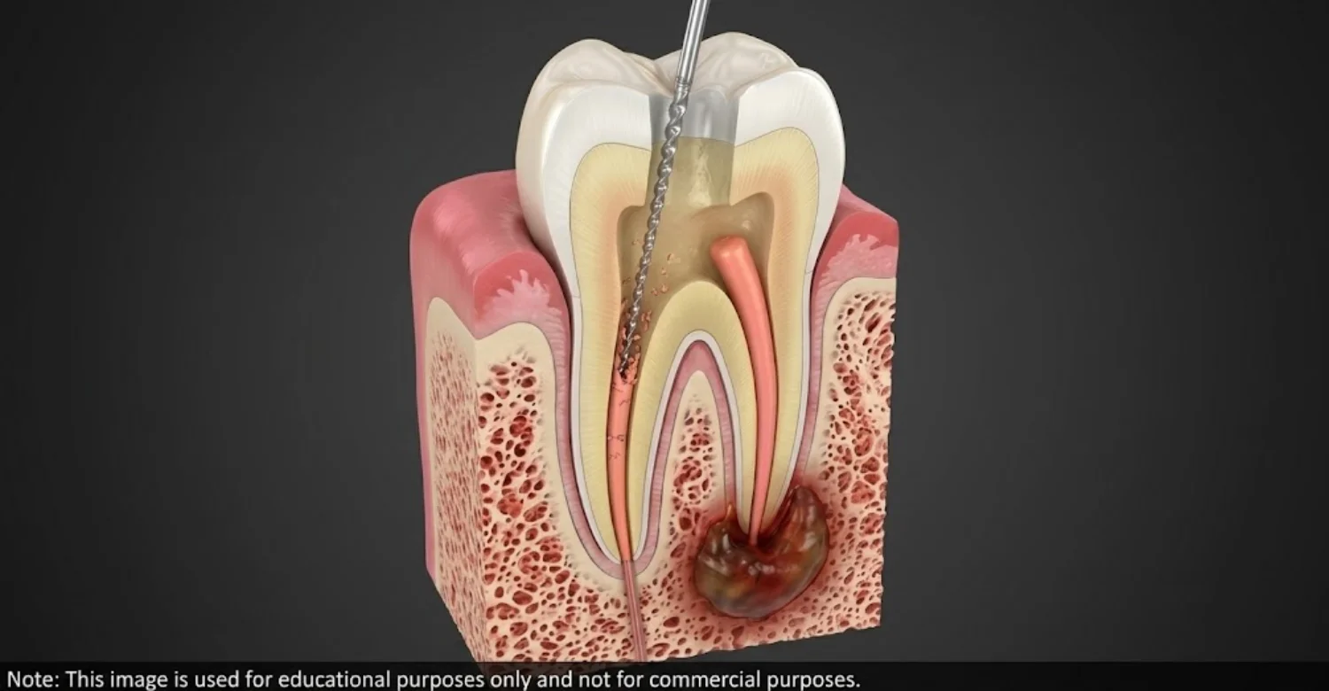 Second Root Canal on Same Tooth